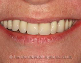 Dental Implants in Hertford
