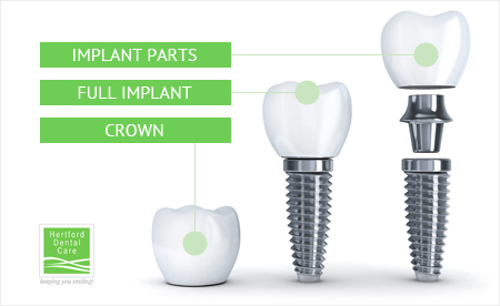 Dental Implants Hertfordshire