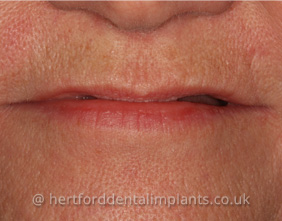 Dental Implants Hertford